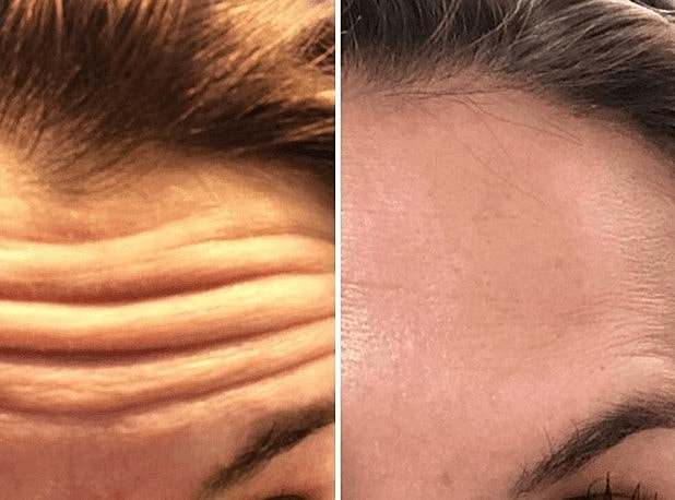 How Safe is Botox®?