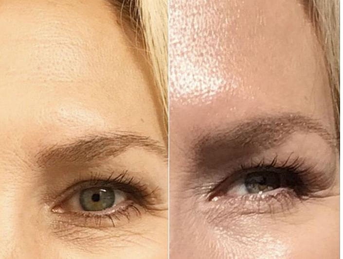 Injectable Treatments 101: What You Should Know