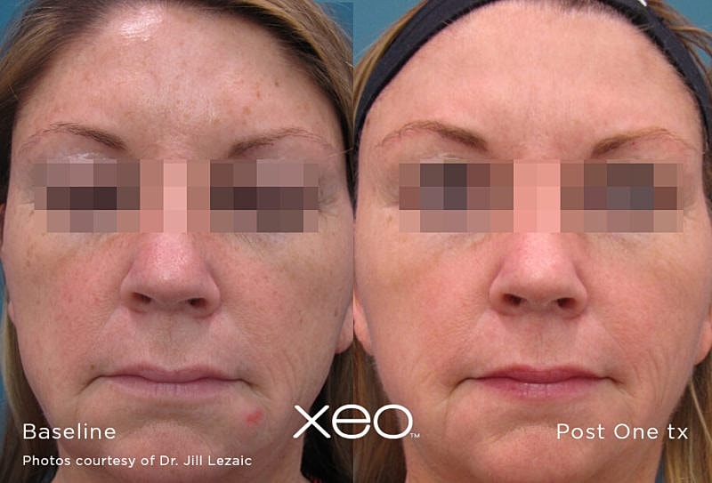 Before and after skin treatment comparison.