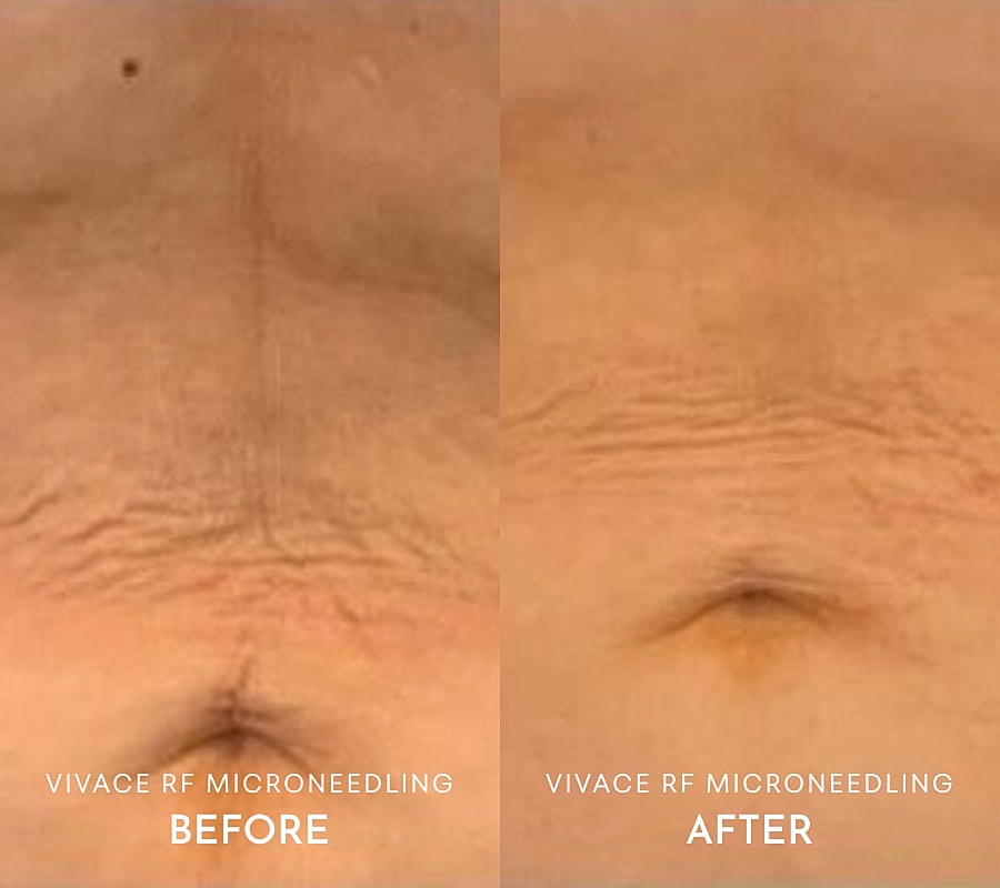 Before and after Vivace RF microneedling results