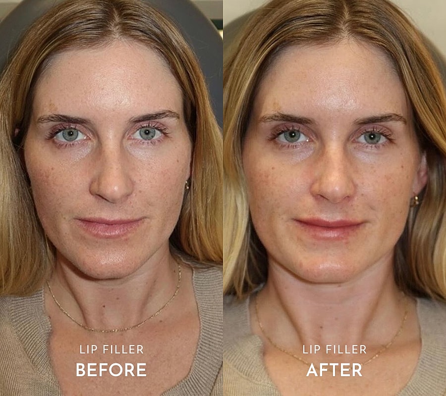 Lip filler transformation before and after images