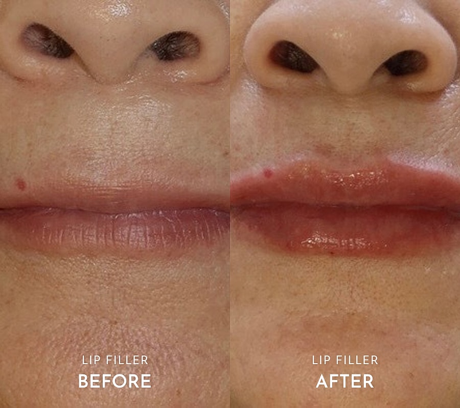 Before and after lip treatment comparison.