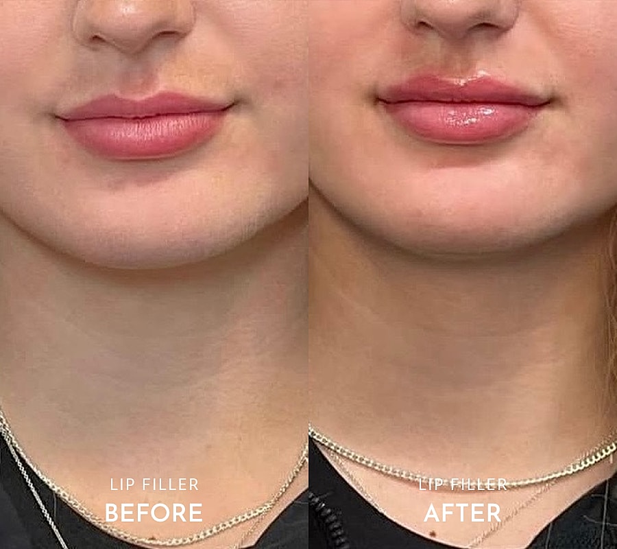 Before and after lip enhancement comparison.