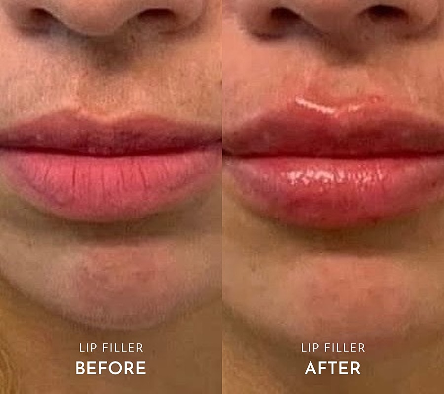 Newport Beach Med Spa patient model comparison of natural and enhanced lips.