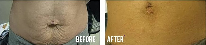 Before and after abdomen appearance comparison