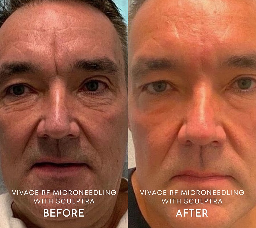 Before and after RF microneedling results.