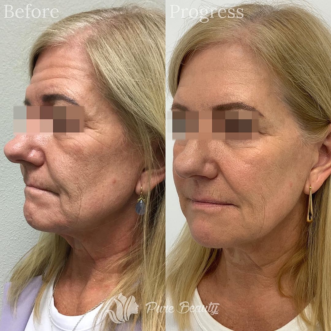 Restylane Before & After