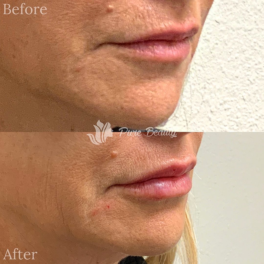 Restylane Before & After