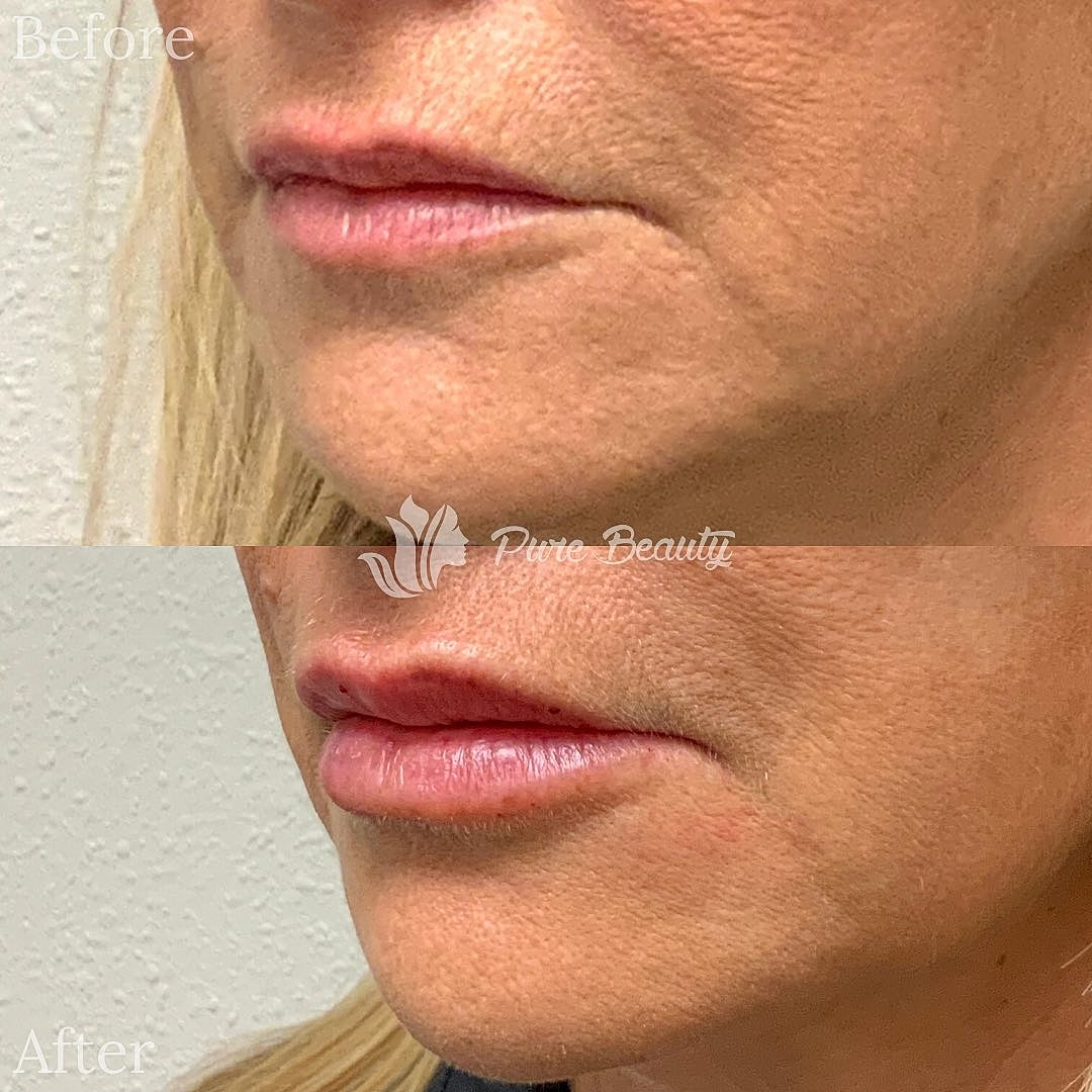 Restylane Before & After