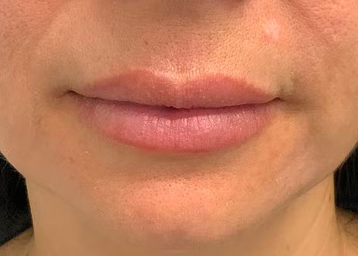 Restylane Before & After