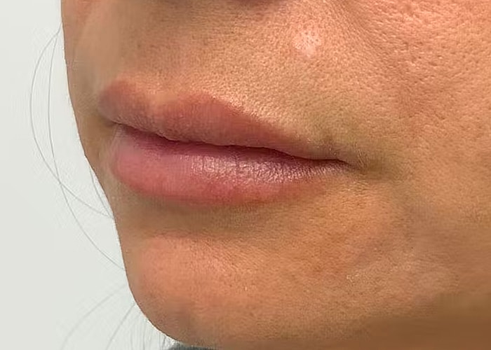 Restylane Before & After