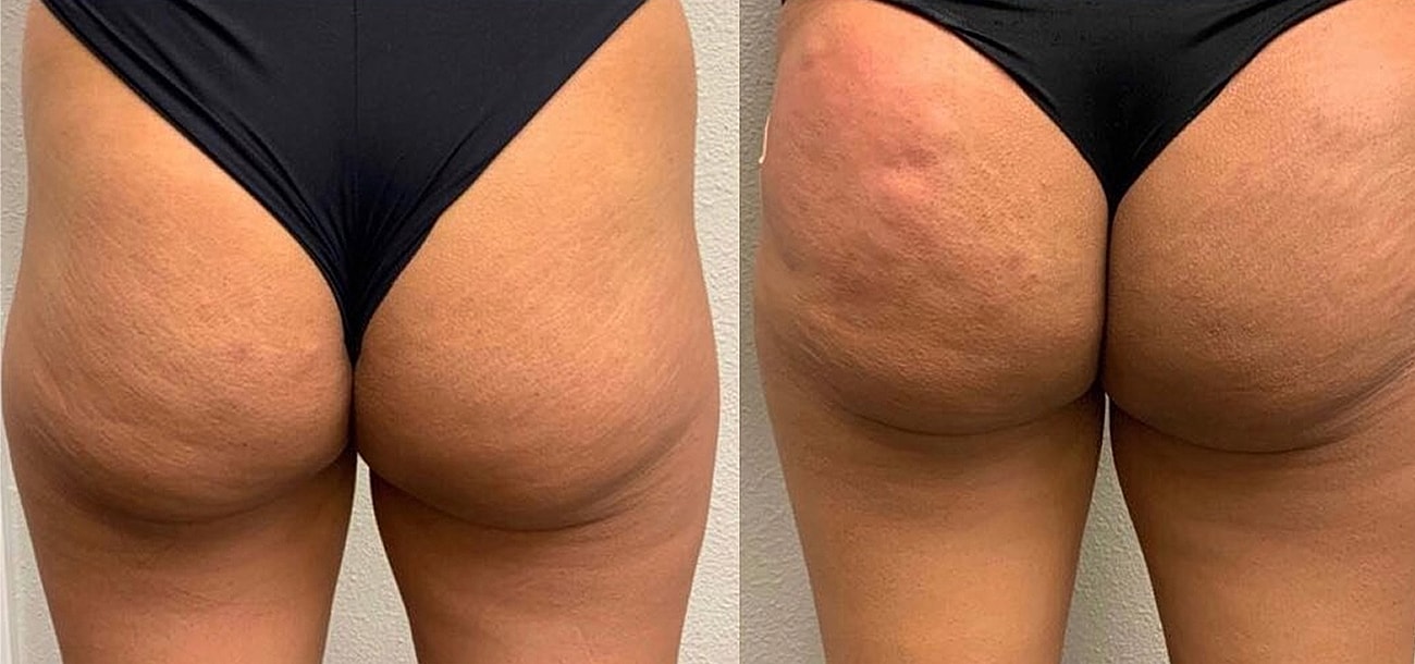 Liquid Butt Lift Before & After