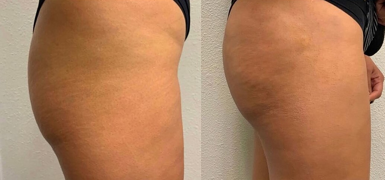 Liquid Butt Lift Before & After