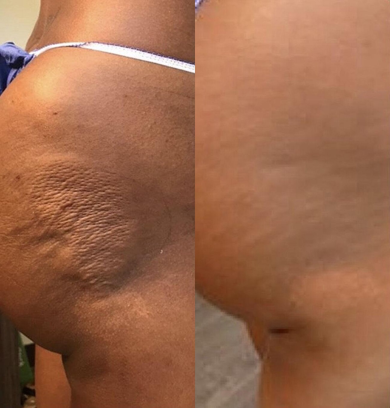 Liquid Butt Lift Before & After