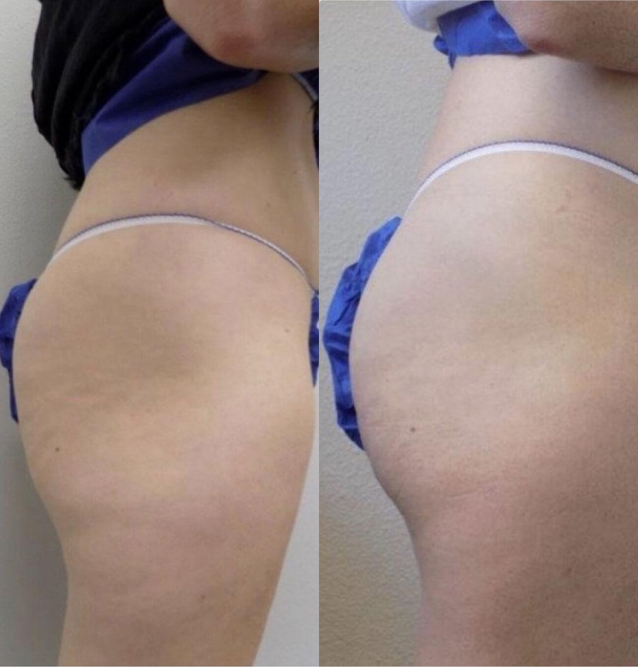 Liquid Butt Lift Before & After