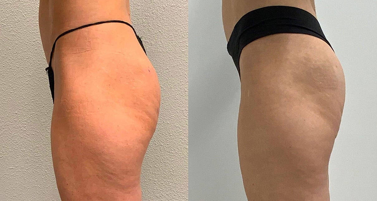 Liquid Butt Lift Before & After