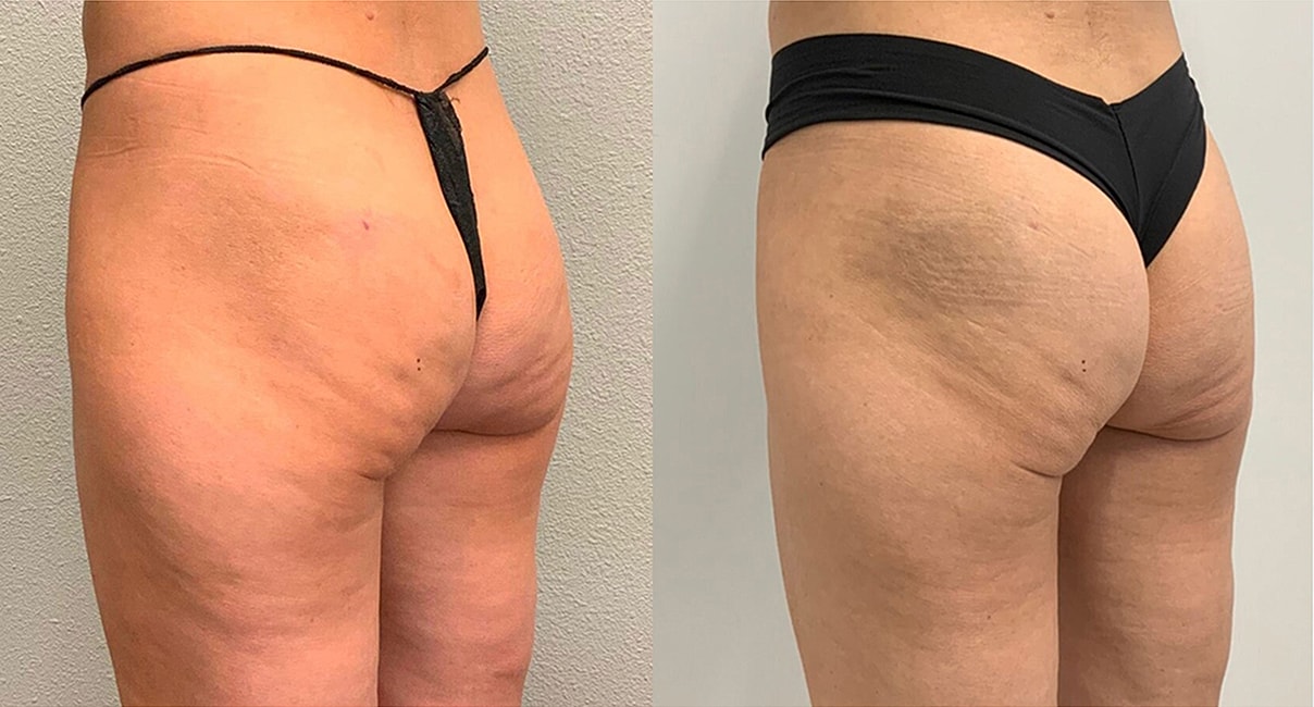 Liquid Butt Lift Before & After