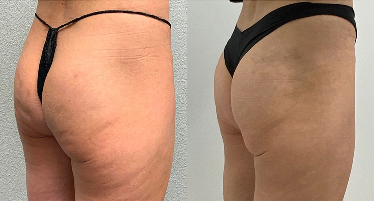 Liquid Butt Lift Before & After