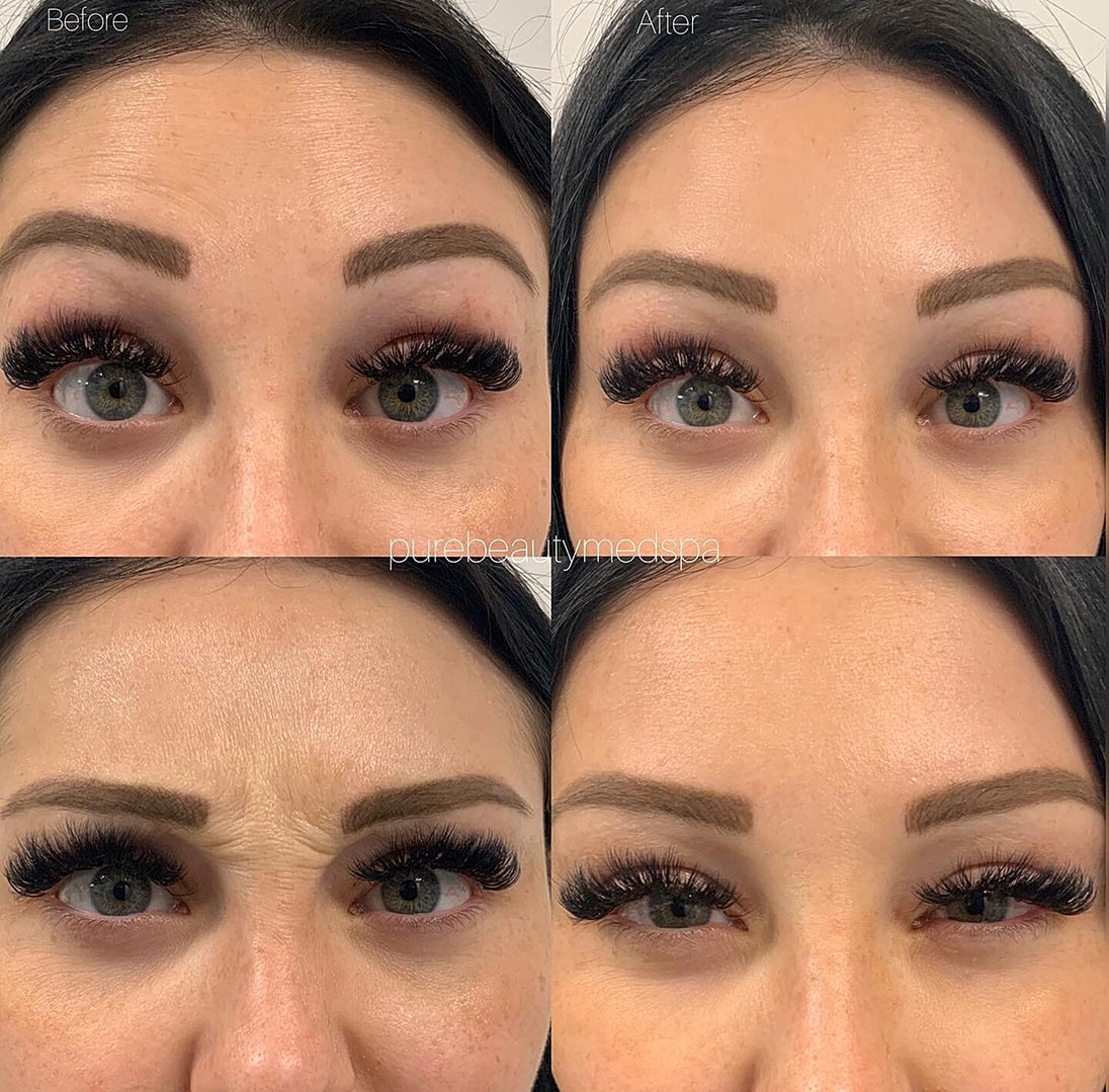 Botox Before & After