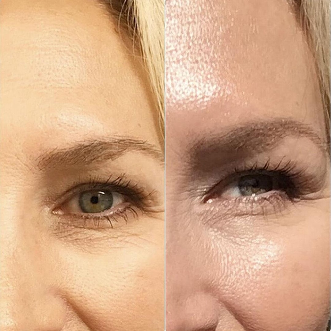 Botox Before & After