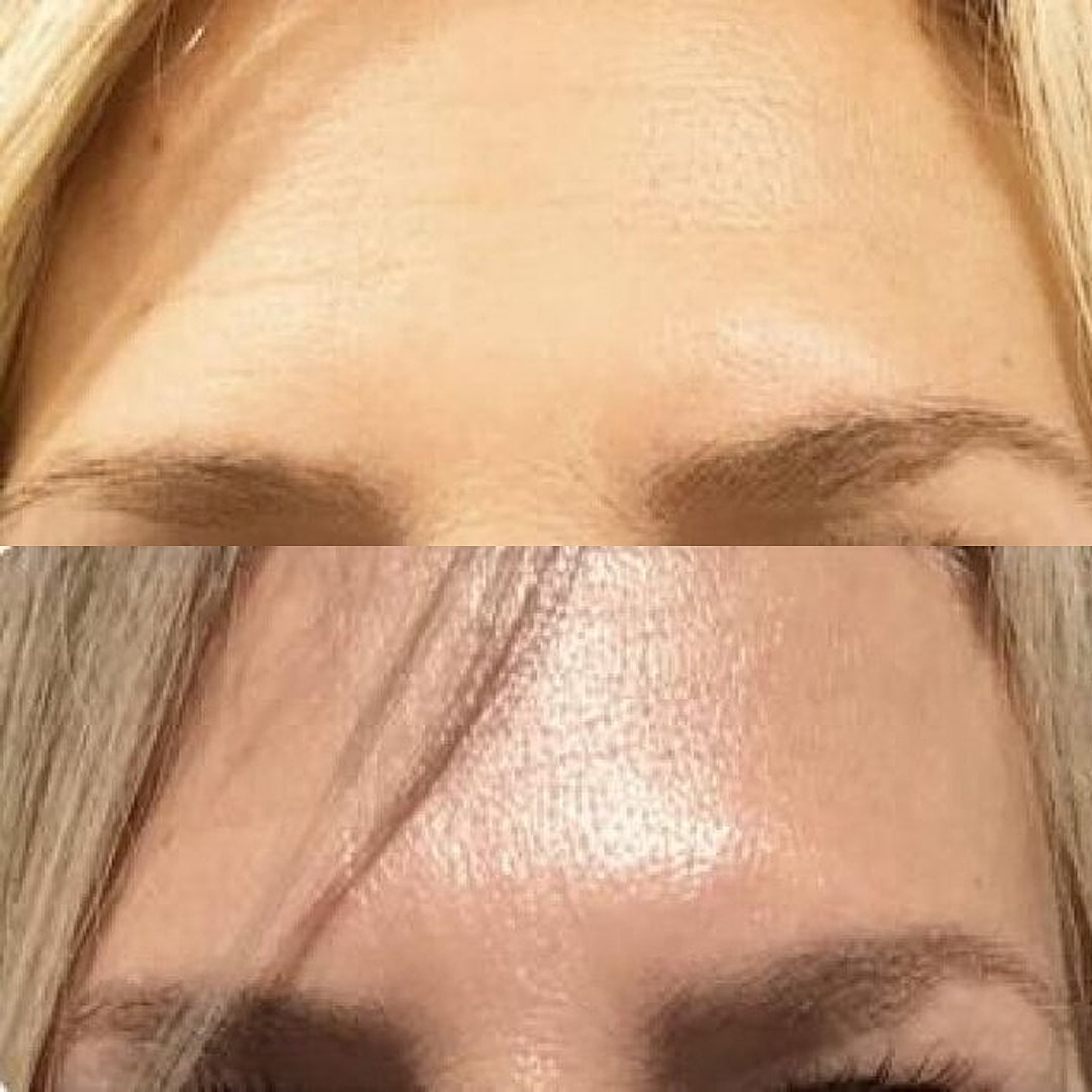 Botox Before & After