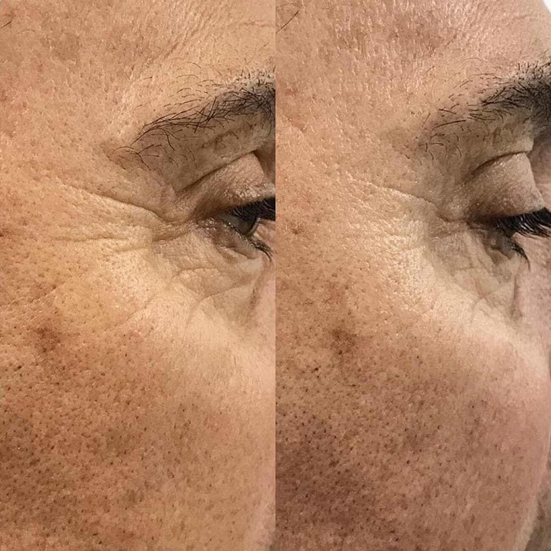 Botox Before & After
