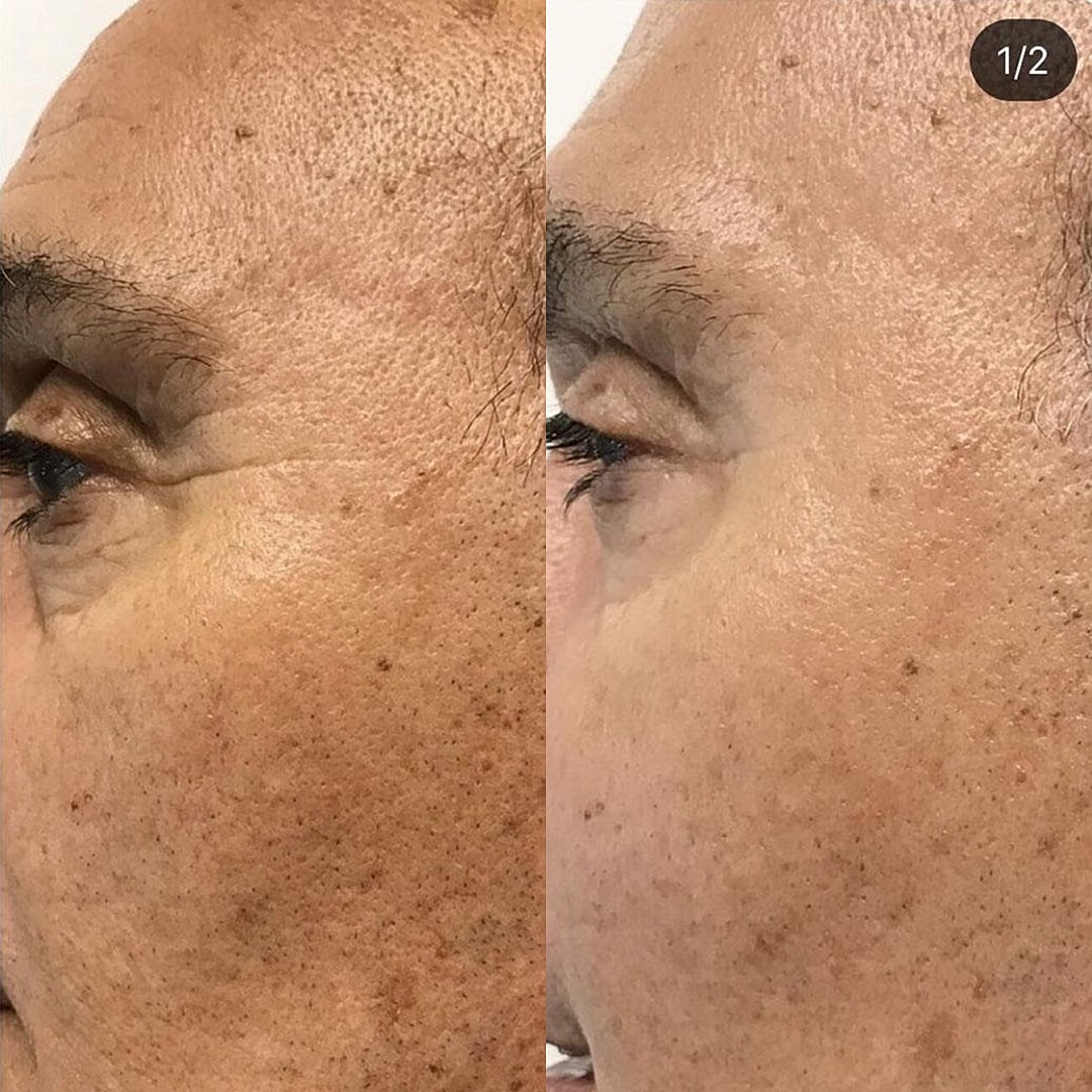 Botox Before & After