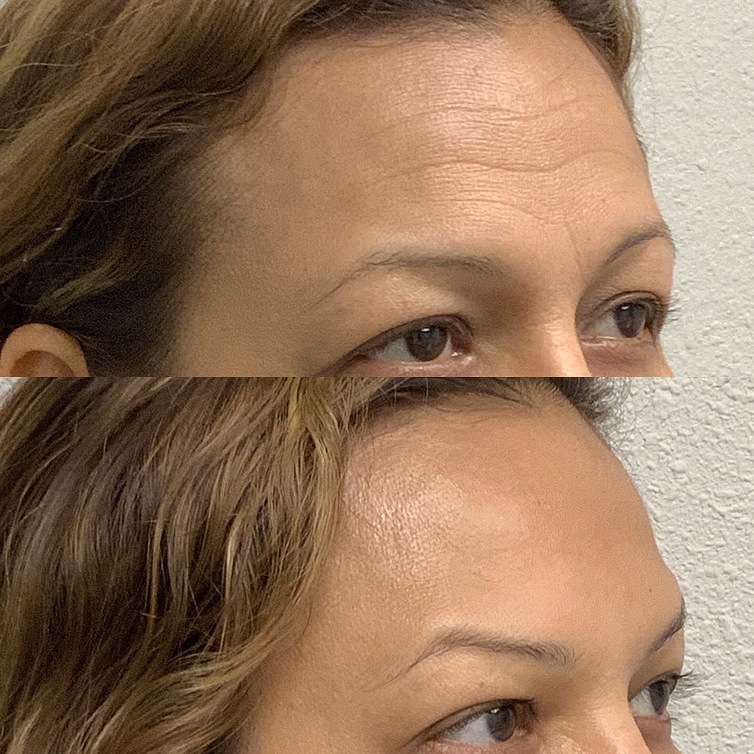 Botox Before & After