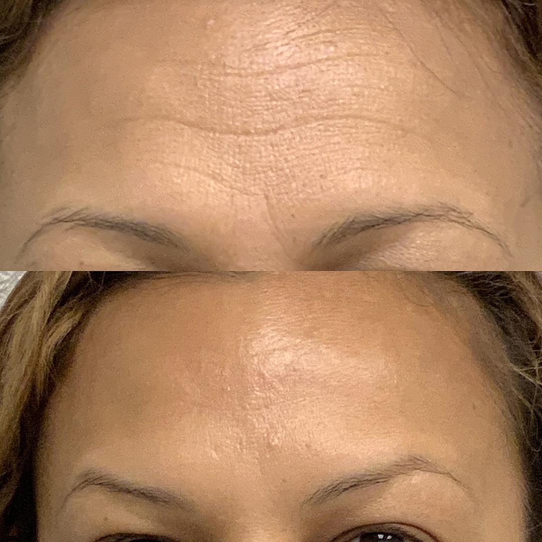 Botox Before & After