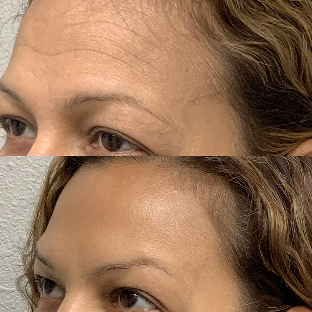 Botox Before & After