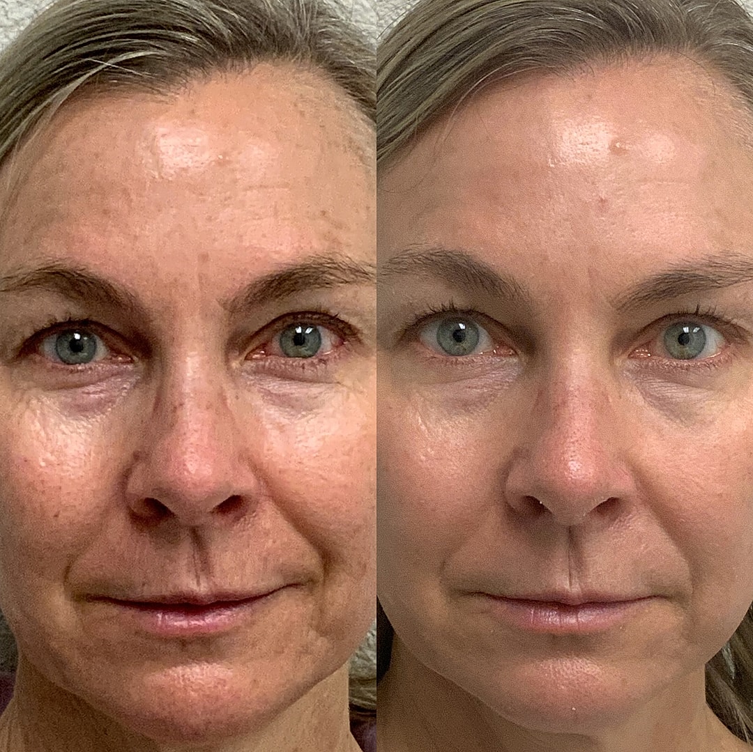 Botox Before & After