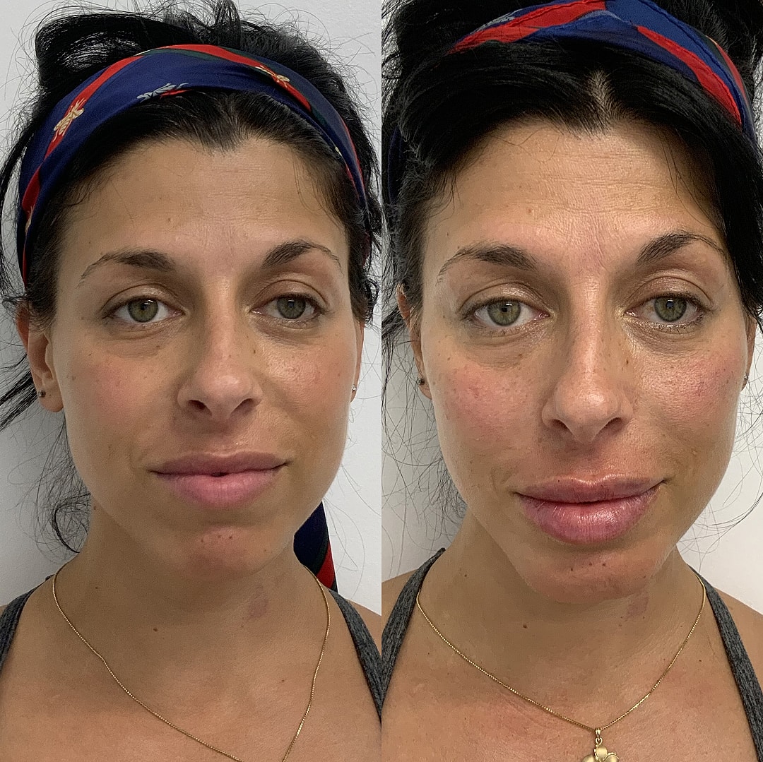 Botox Before & After