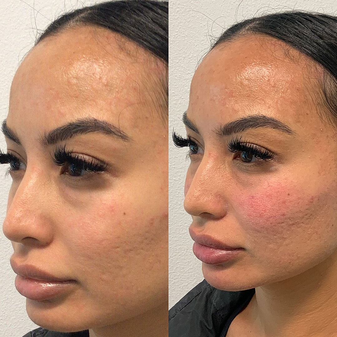 Botox Before & After