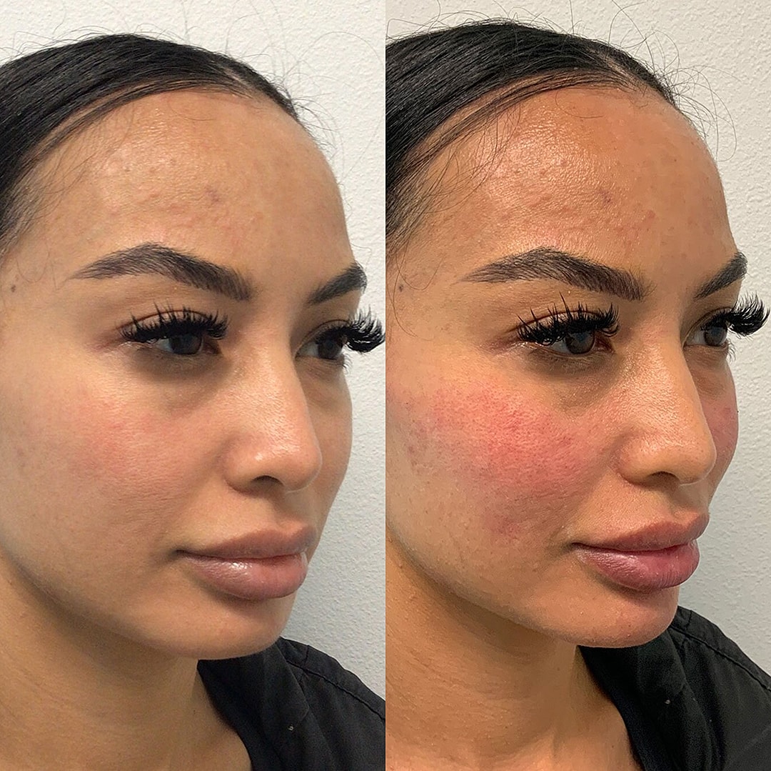 Botox Before & After