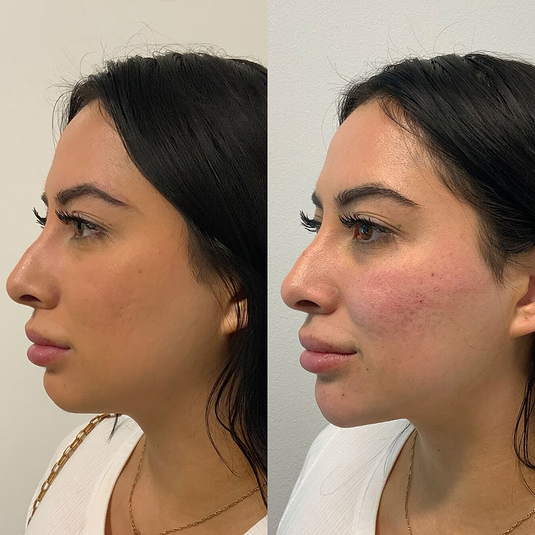 Botox Before & After