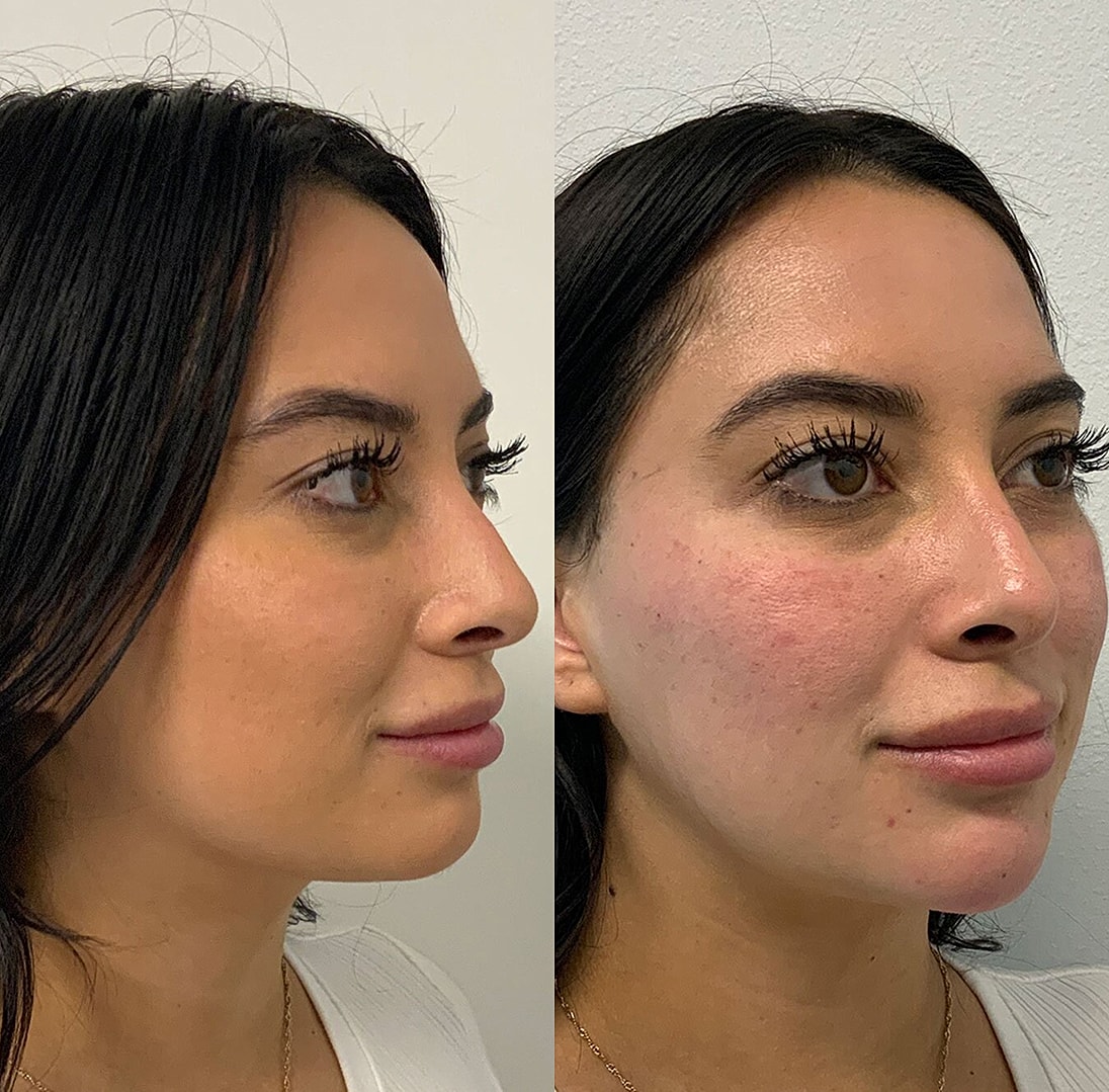 Botox Before & After