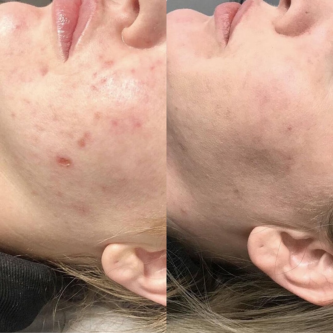 Pearl Fusion Before & After