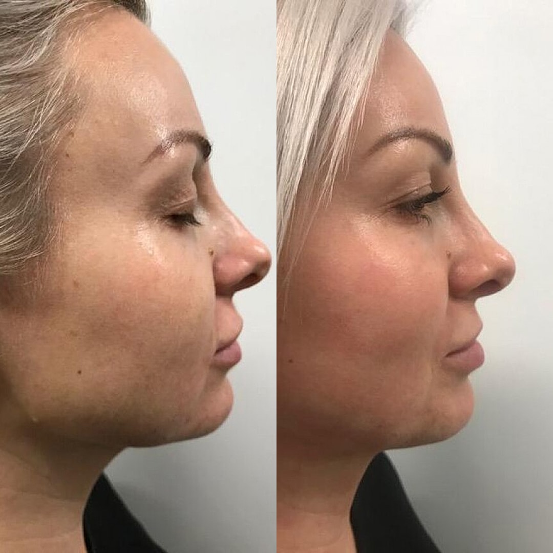 Pearl Fusion Before & After