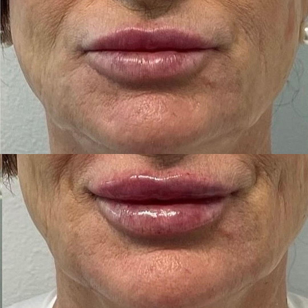 Lip Filler Before & After