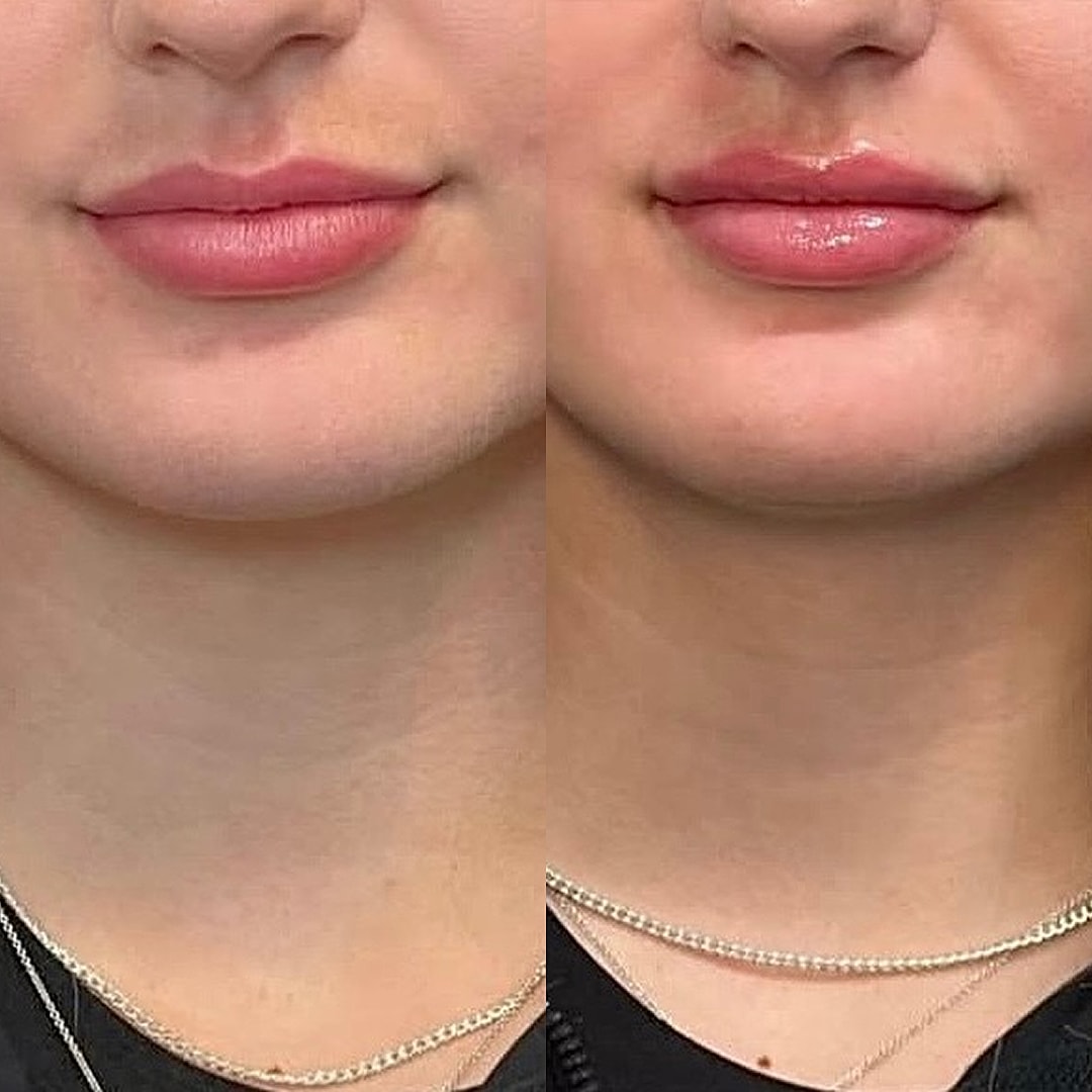 Lip Filler Before & After