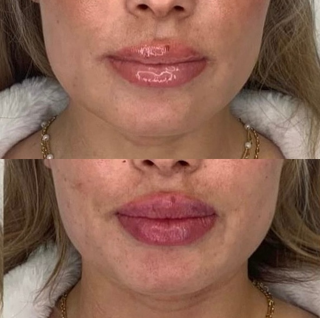 Lip Filler Before & After