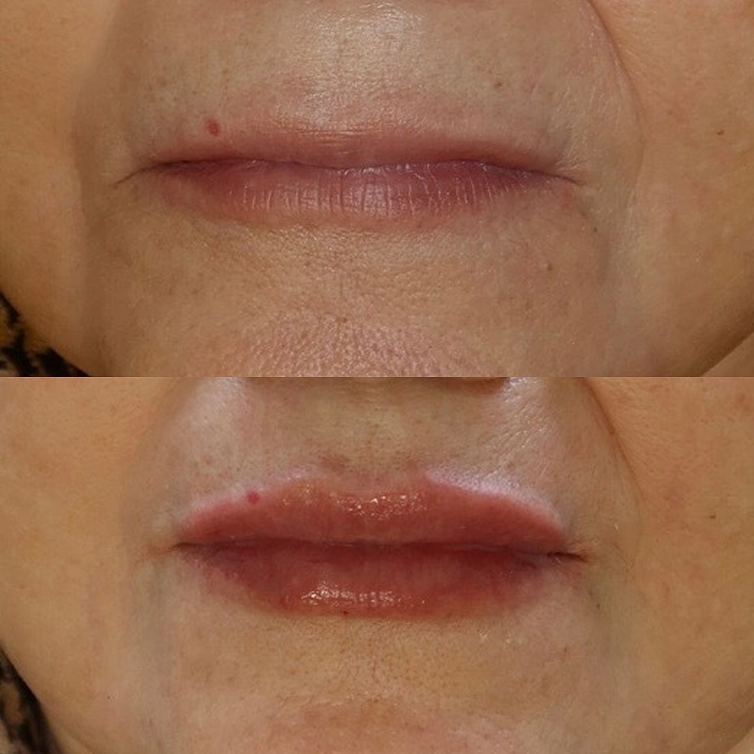 Lip Filler Before & After