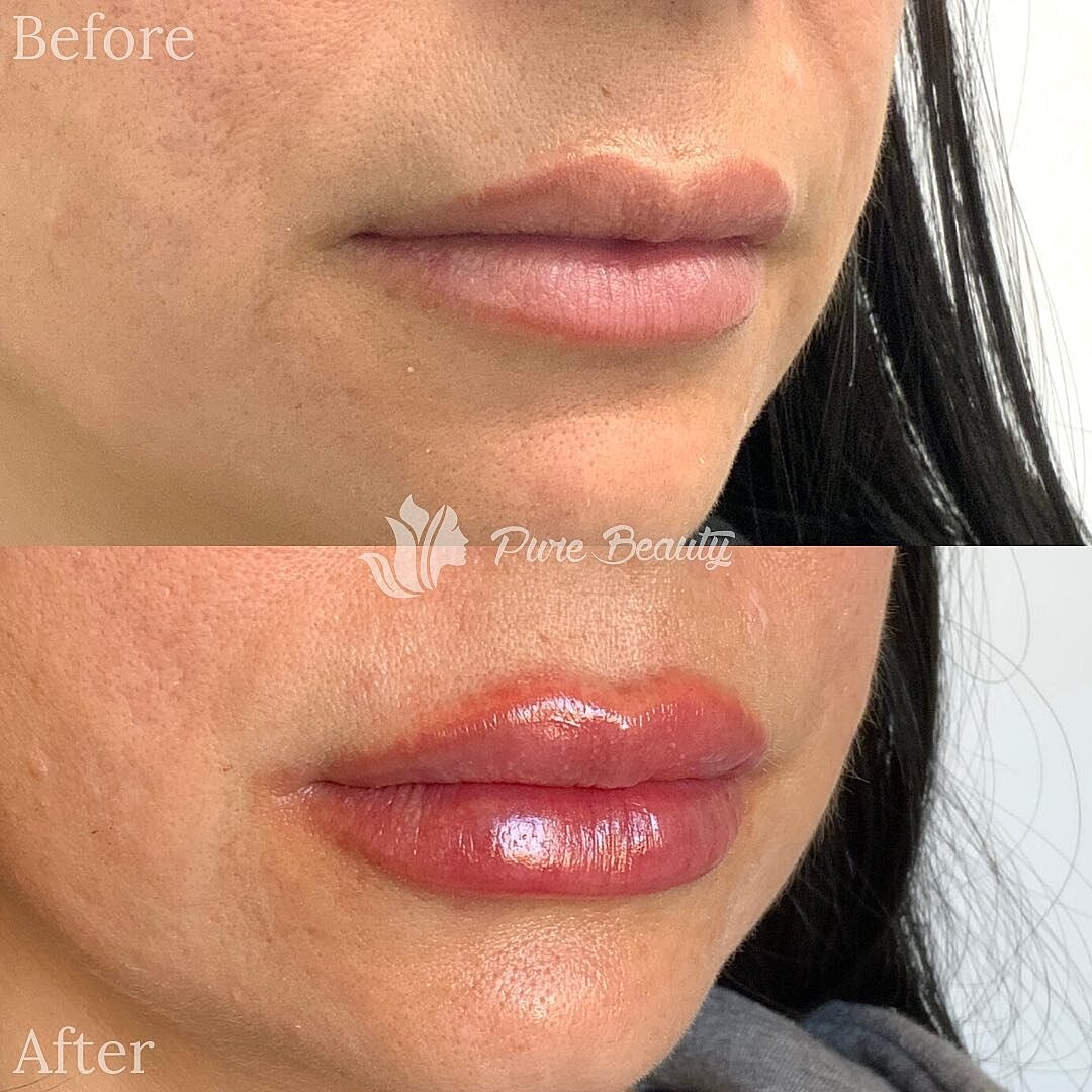 Lip Filler Before & After