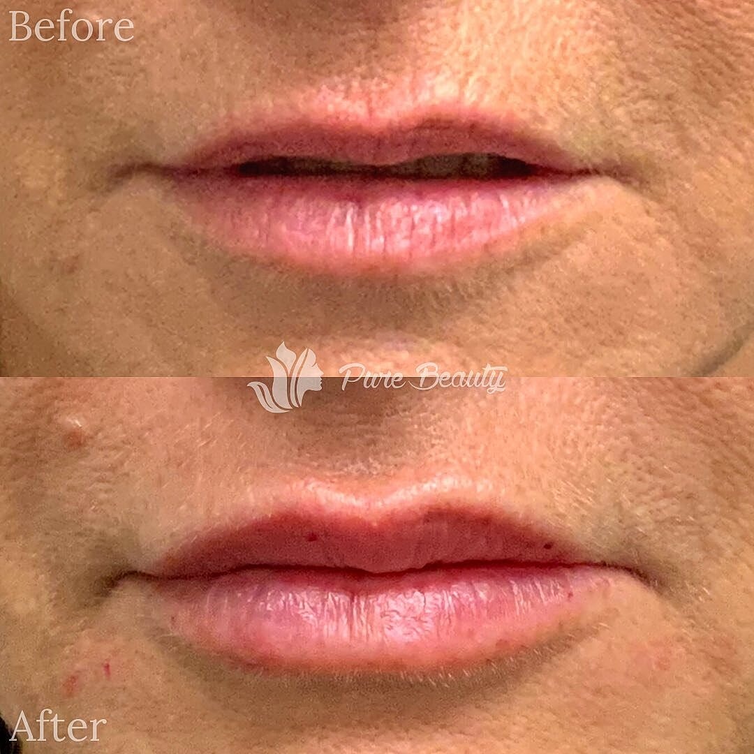 Lip Filler Before & After