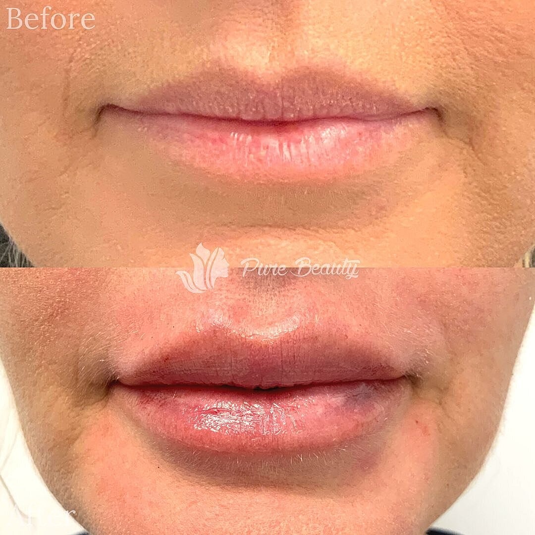 Lip Filler Before & After