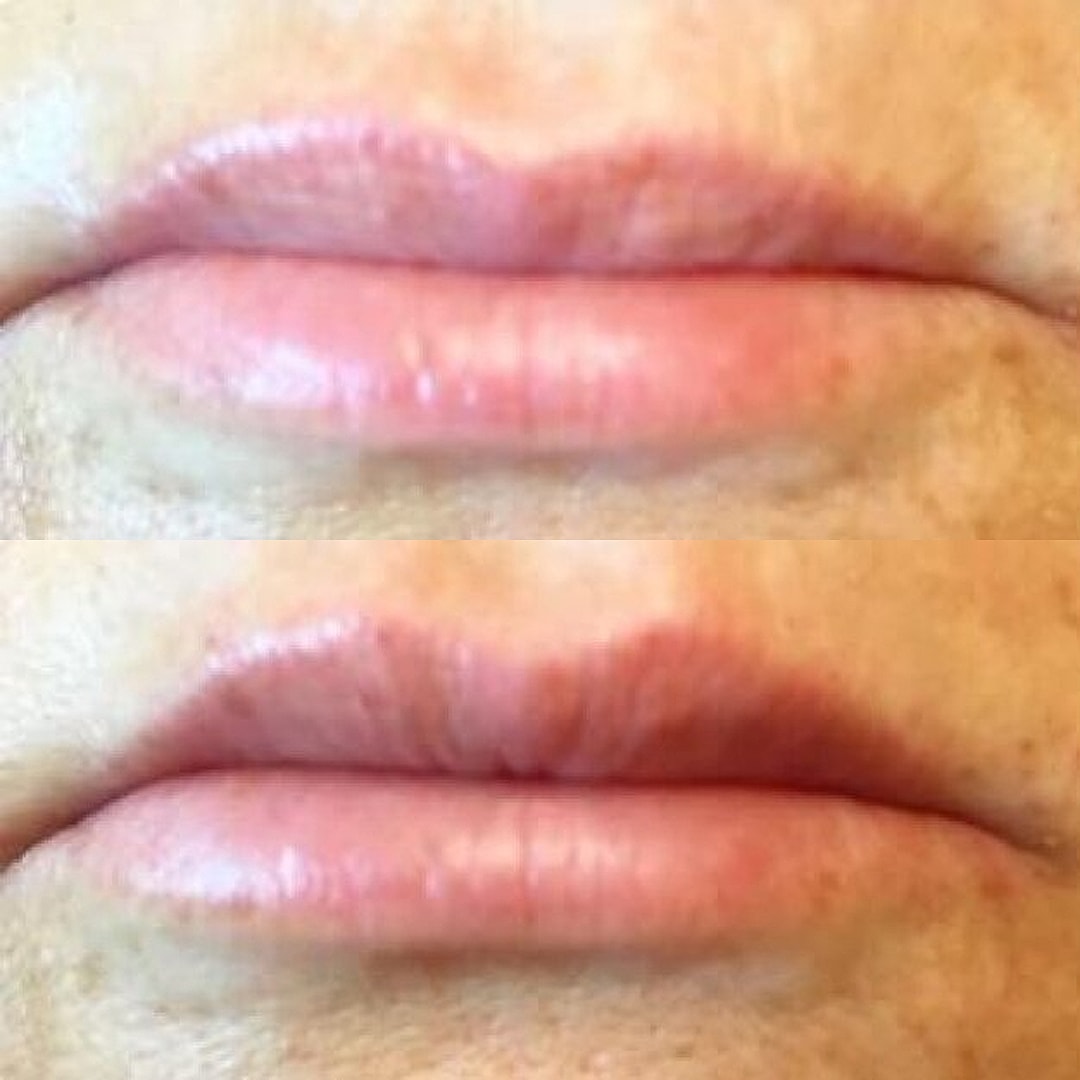Lip Filler Before & After