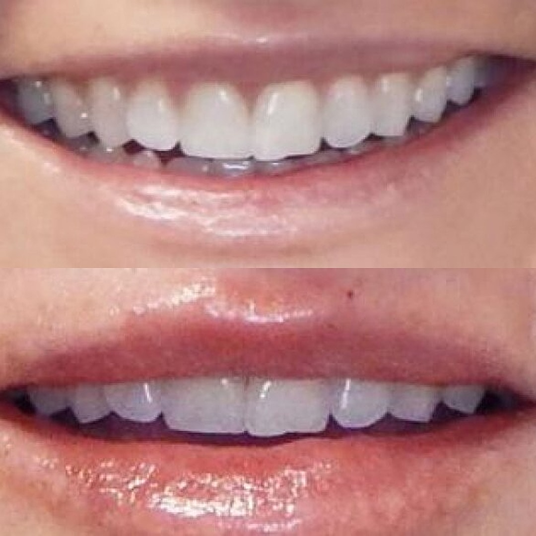Lip Filler Before & After