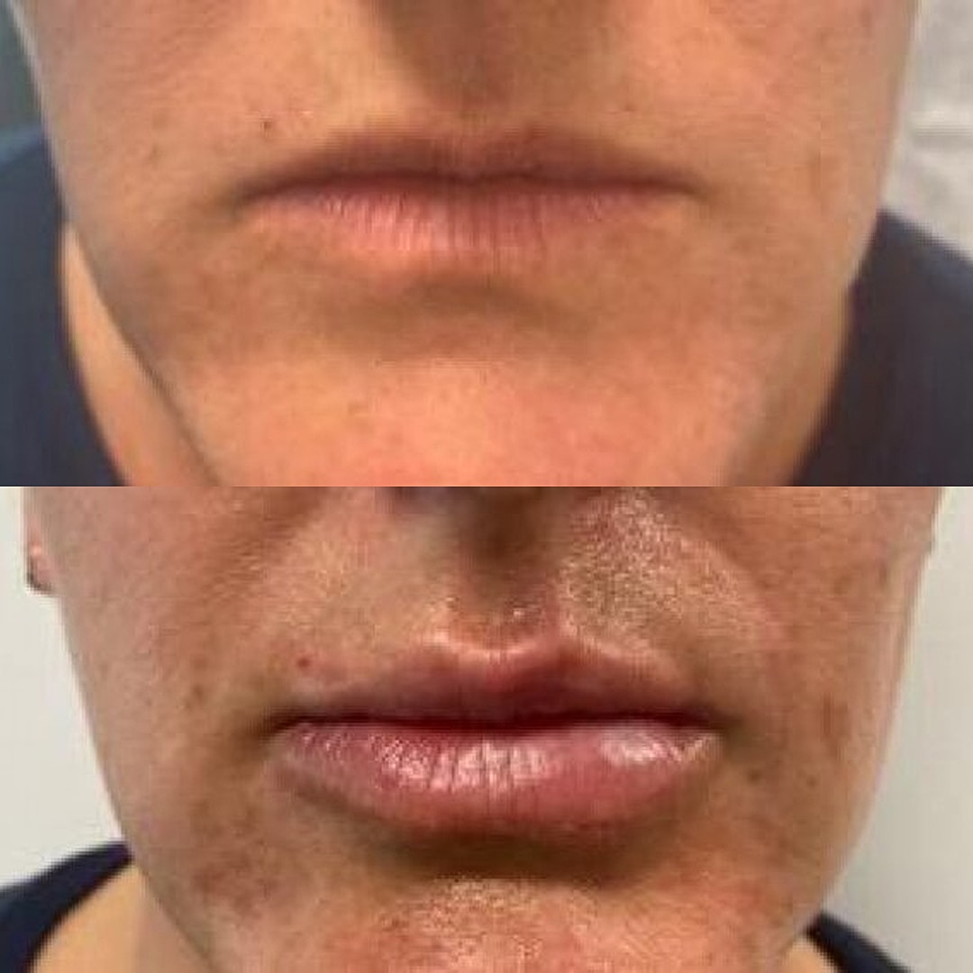 Lip Filler Before & After