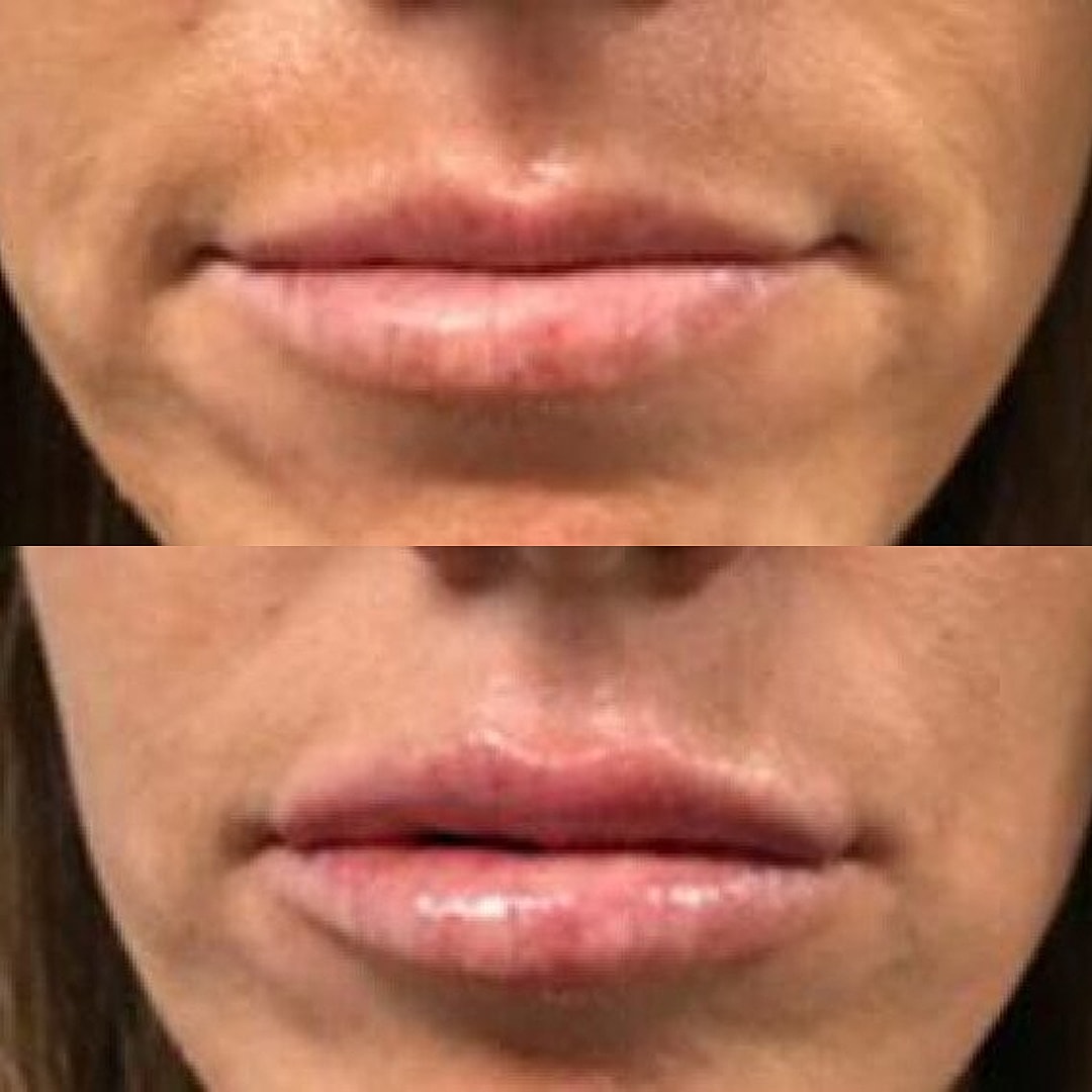 Lip Filler Before & After