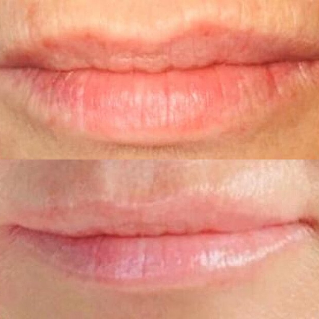 Lip Filler Before & After
